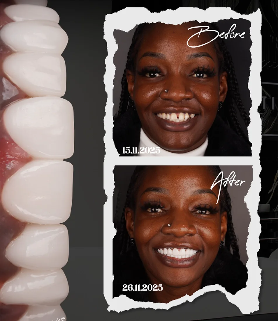 The Result A Fixed Smile Built Around Her Own Teeth