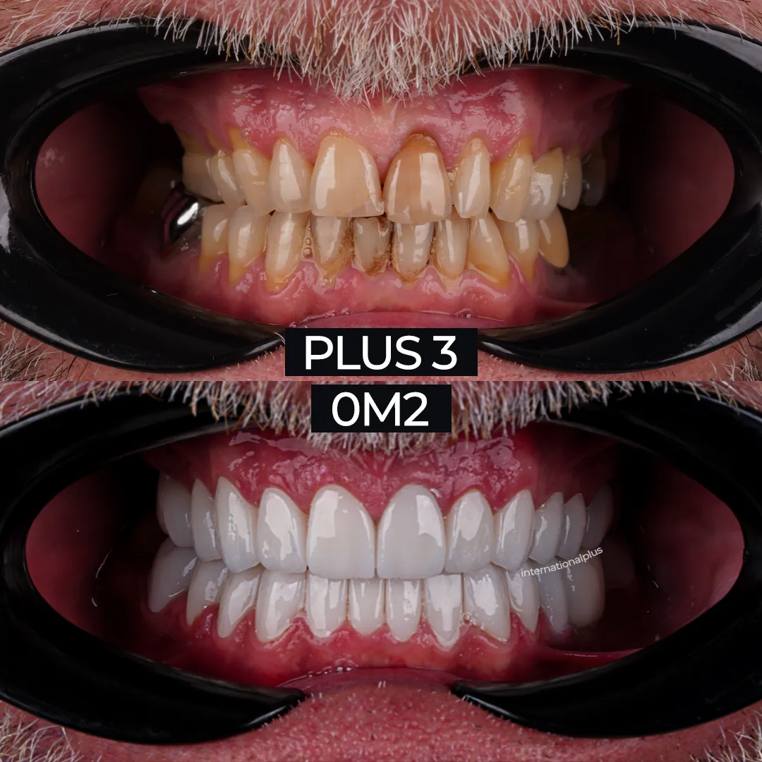 The Result A Fixed Smile Built on His Own Teeth