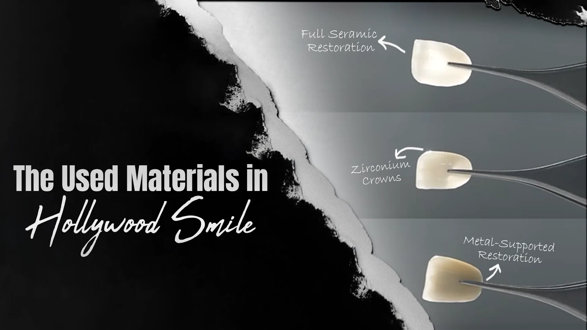 The-Used-Materials-In-Hollywood-Smile