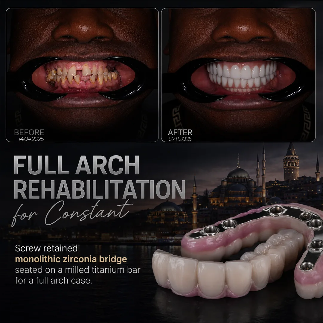 The Zirconia Bridge and the Digital Workflow