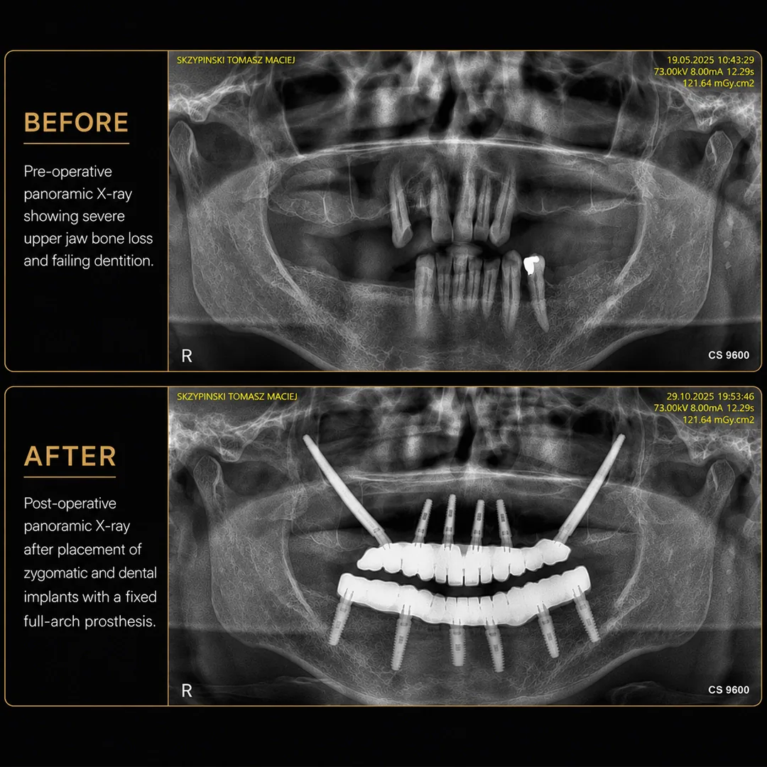 Tomasz's Story When the Upper Jaw Runs Out of Bone