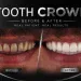 Tooth Crown Before and After Realistic Results Explained