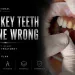 Turkey Teeth Gone Wrong Causes, Signs & How to Avoid