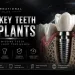 Turkey Teeth Implants Options, Process & All on 4
