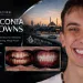 Zirconia Crowns Smile Transformation Aleksandr's Case