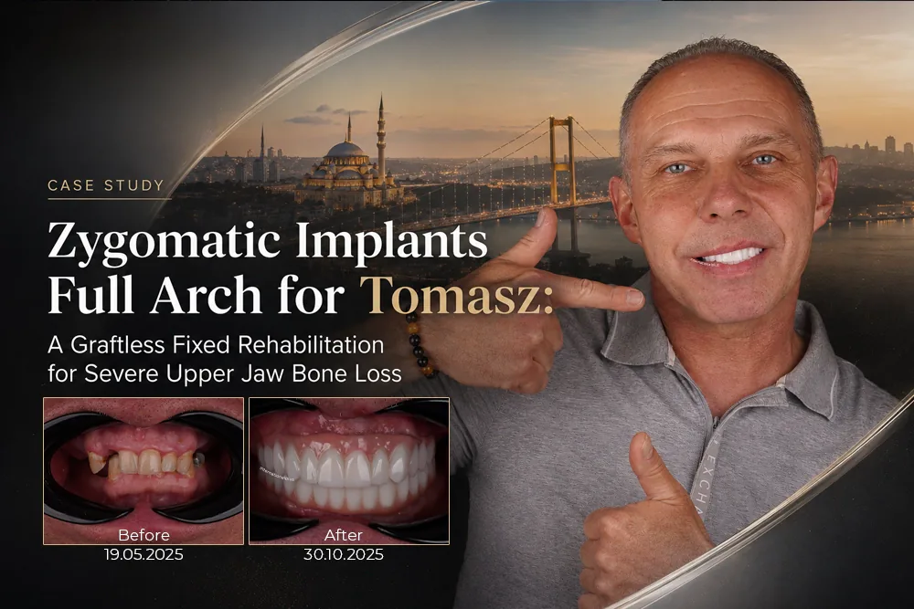 Zygomatic Implants Full Arch for Tomasz: A Graftless Fixed Rehabilitation for Severe Upper Jaw Bone Loss