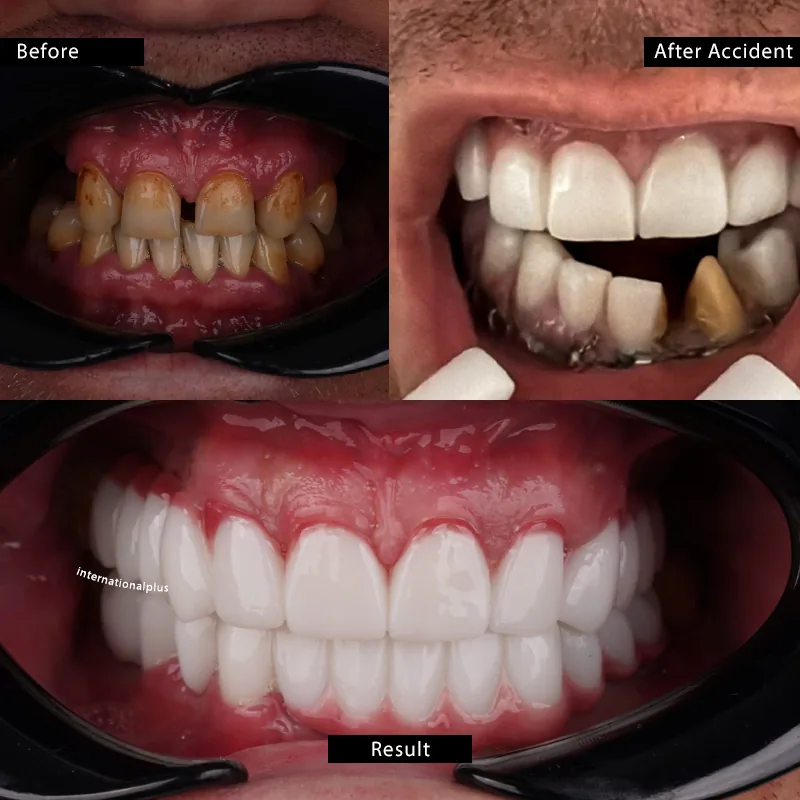 2022 to 2023 Five Implants, an Apical Resection and a Four Appointment Delivery