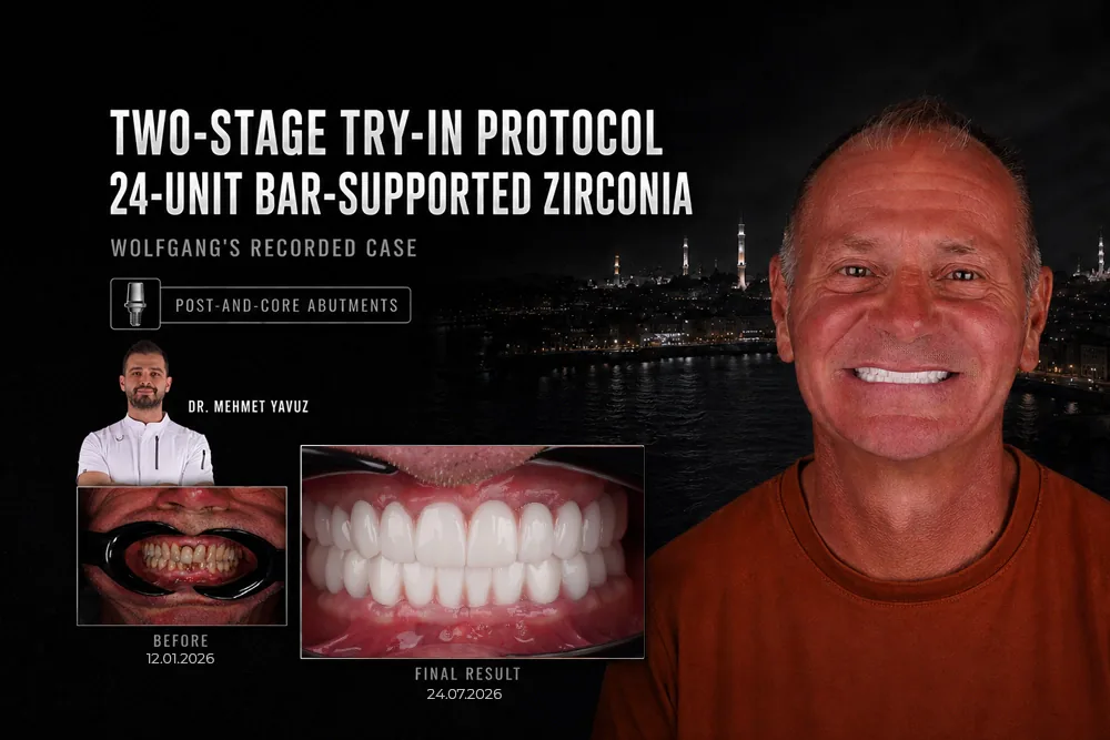 A Two Stage Try In Protocol for Wolfgang: Post and Core Abutments Beneath a 24 Unit Bar Supported Zirconia Rehabilitation
