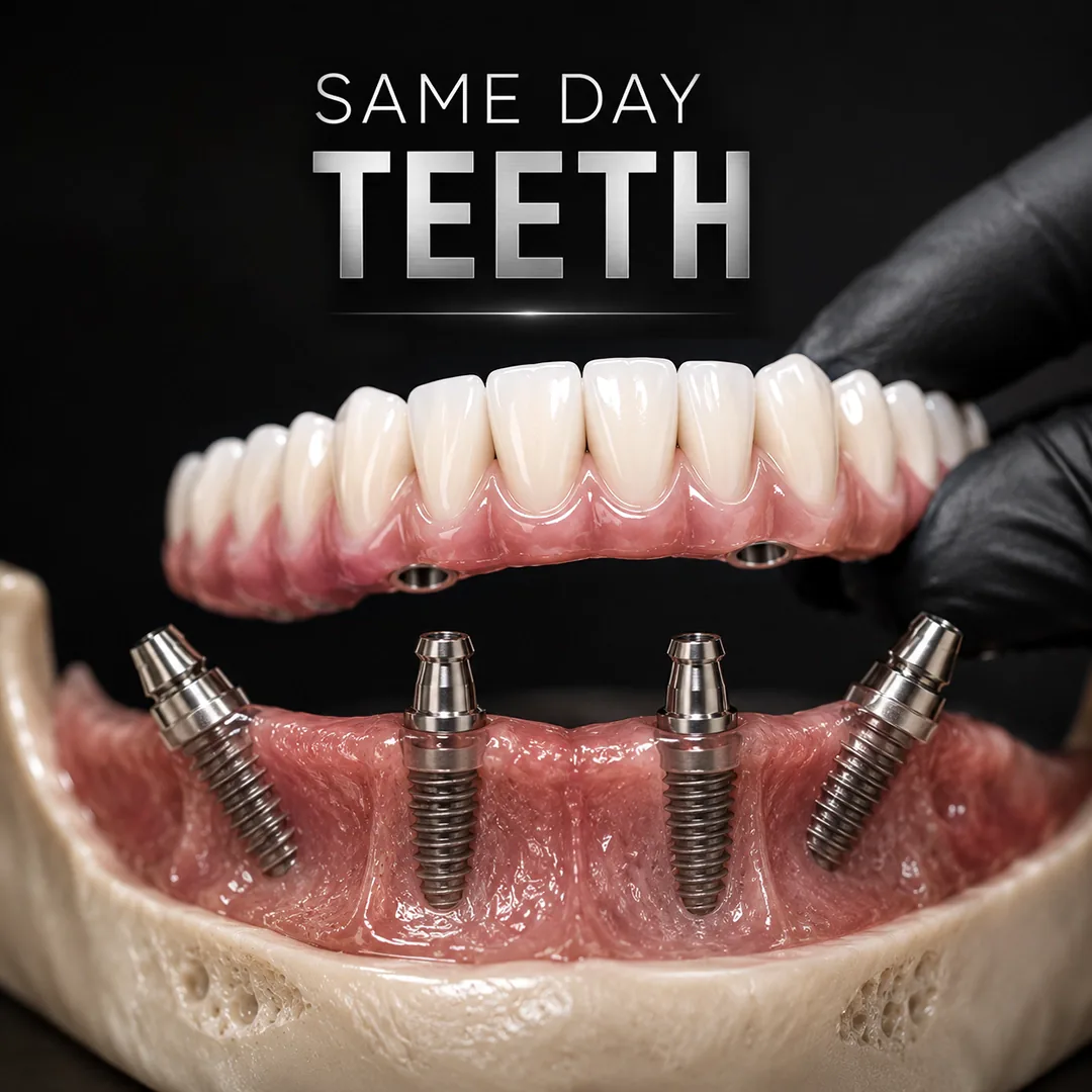 All on 4 vs All on 6 vs Traditional Implants