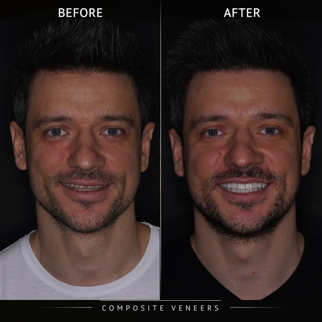 Composite Veneers vs Porcelain Veneers What Is the Difference