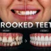 Crooked Teeth What Causes Them and How to Fix Misaligned Teeth