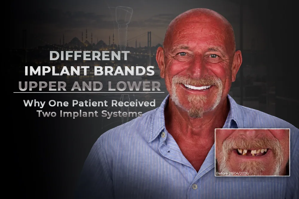 Different Implant Brands Upper and Lower: Why One Patient Received Two Implant Systems