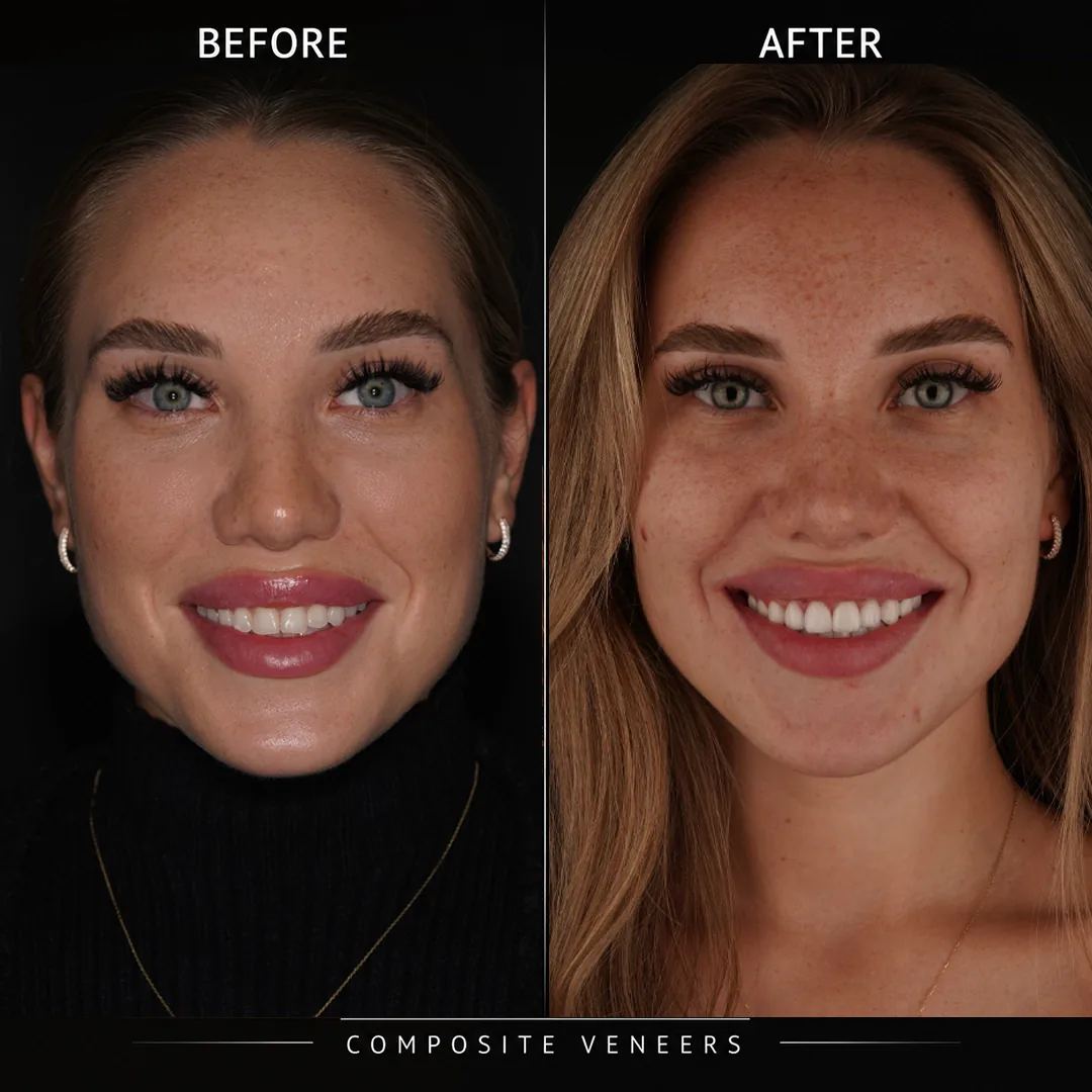 How Durable Are Composite Veneers and How Do They Stain