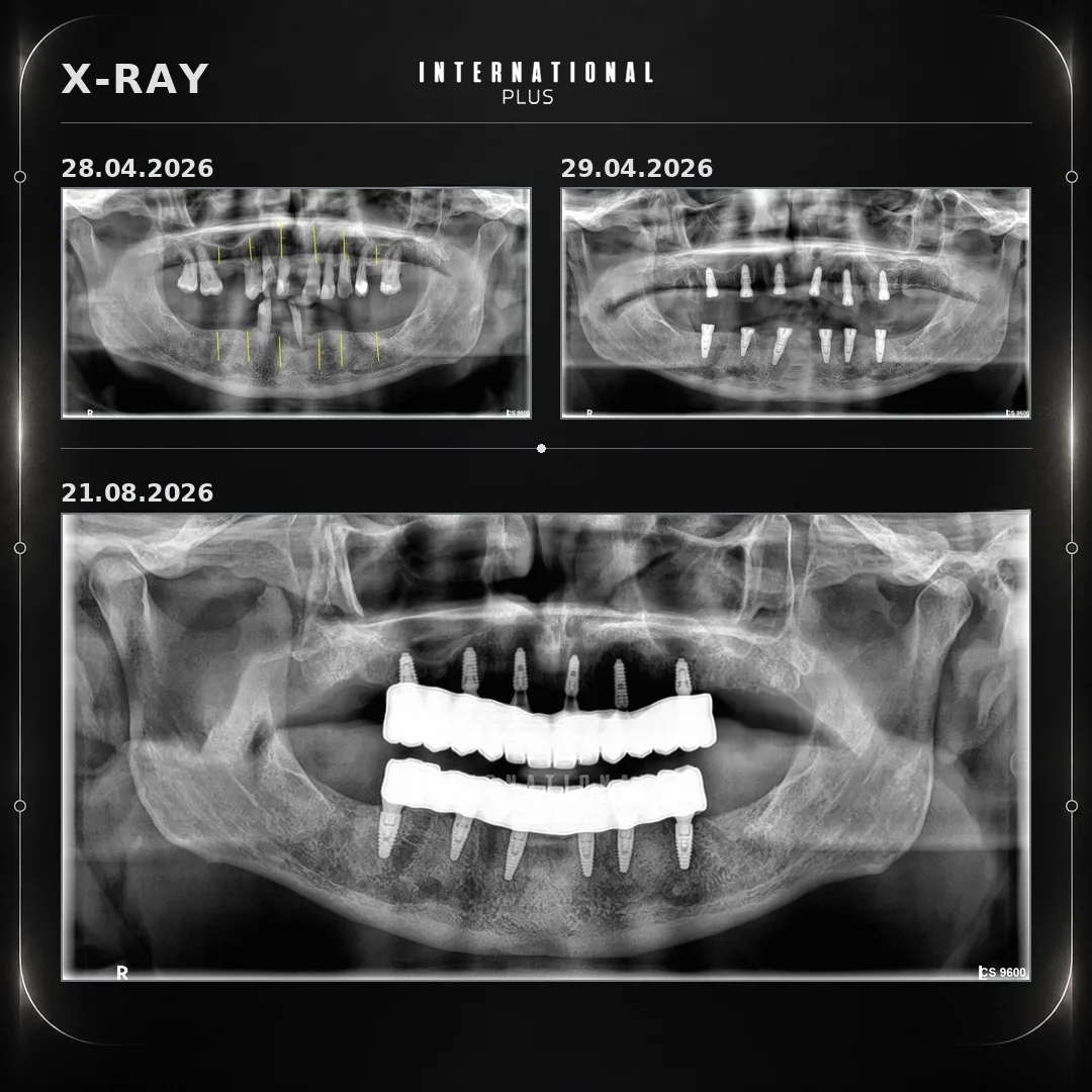 Megagen in the Upper Jaw, BEGO in the Lower