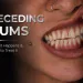 Receding Gums What Causes Recession and How to Fix It