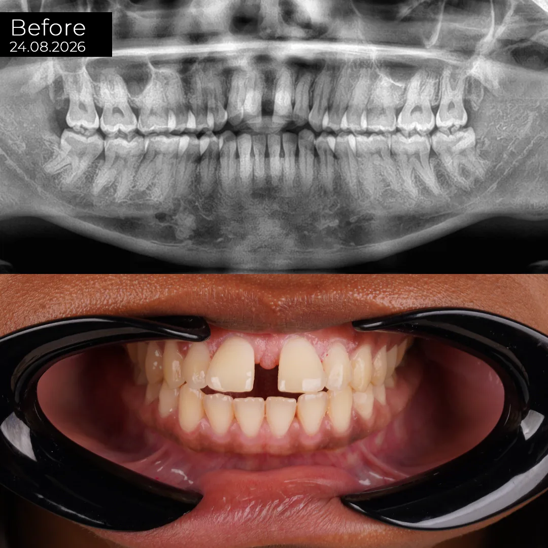Why Endodontic Status Is Checked Before Any Crown Is Planned