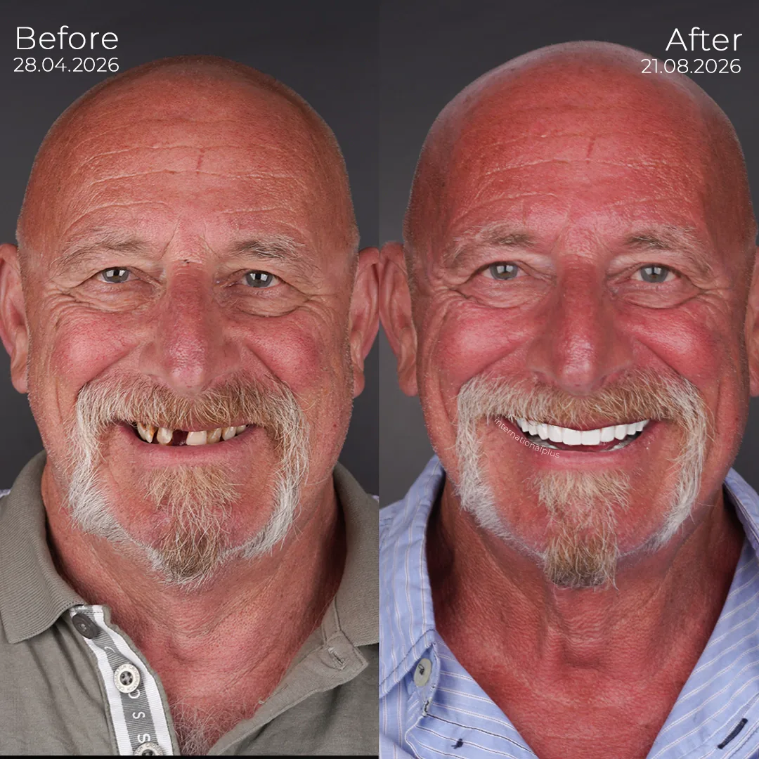 Why an Implant Brand Is Chosen Per Jaw, Not Per Patient