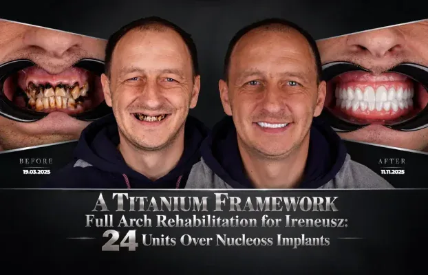 A Titanium Framework Full Arch Rehabilitation for Ireneusz: 24 Units Over Nucleoss Implants