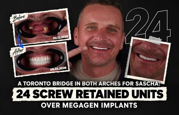 A Toronto Bridge in Both Arches for Sascha: 24 Screw Retained Units Over Megagen Implants