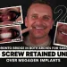A Toronto Bridge in Both Arches for Sascha 24 Screw Retained Units Over Megagen Implants
