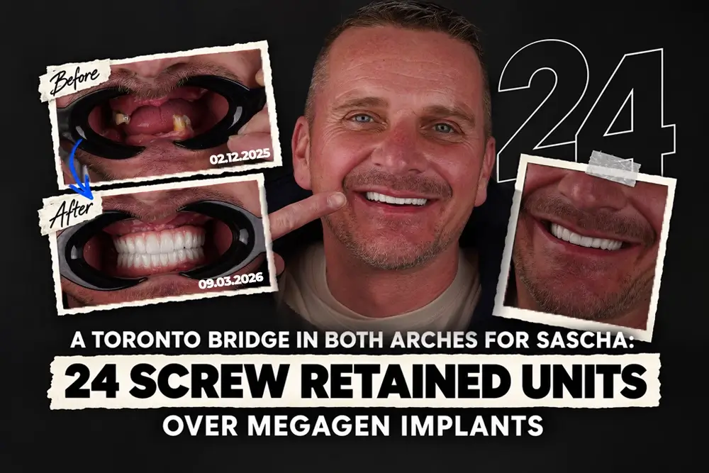A Toronto Bridge in Both Arches for Sascha: 24 Screw Retained Units Over Megagen Implants
