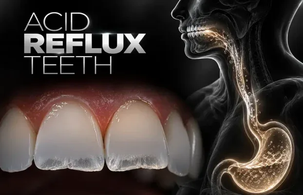 Acid Reflux Teeth: Erosion Signs and What Dentists Do