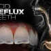Acid Reflux Teeth Erosion Signs and What Dentists Do