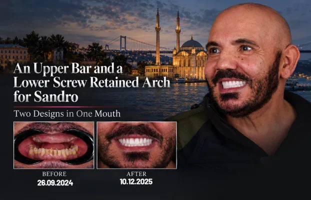 An Upper Bar and a Lower Screw Retained Arch for Sandro: Two Designs in One Mouth