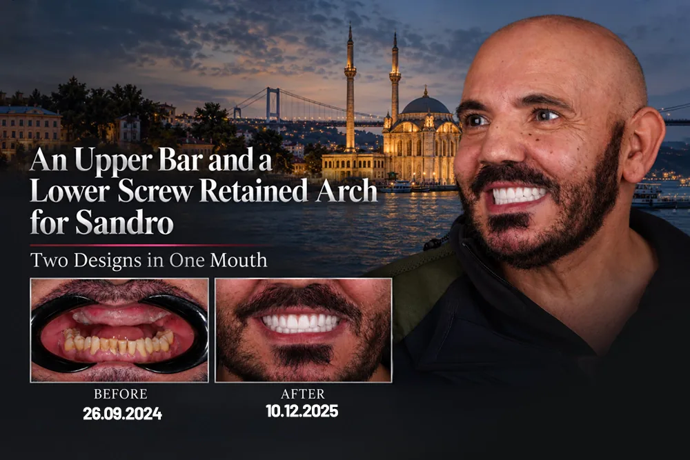 An Upper Bar and a Lower Screw Retained Arch for Sandro: Two Designs in One Mouth