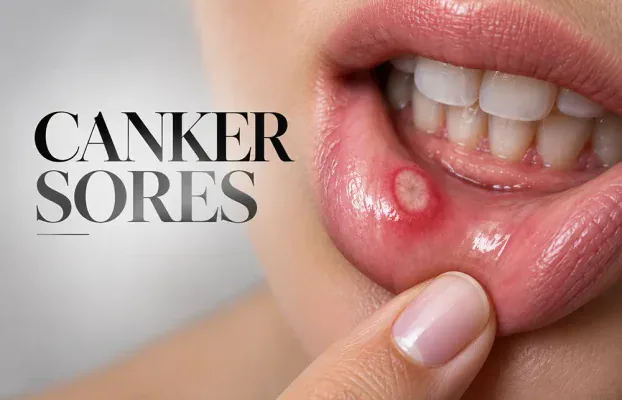 Canker Sores: What Causes Them and How to Get Rid of Them