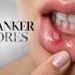 Canker Sores What Causes Them and How to Get Rid of Them