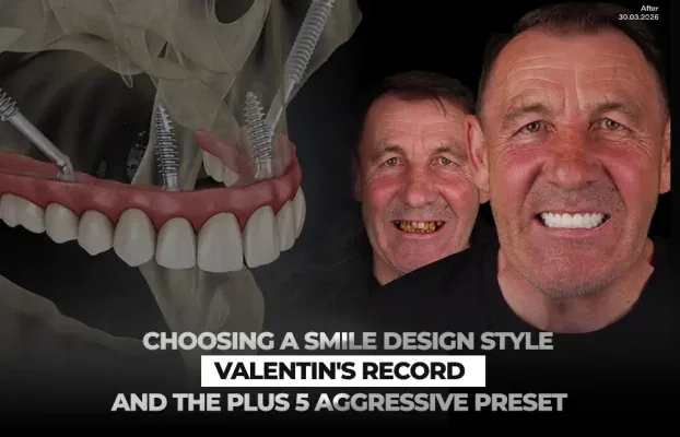 Choosing a Smile Design Style: Valentin’s Record and the Plus 5 Aggressive Preset
