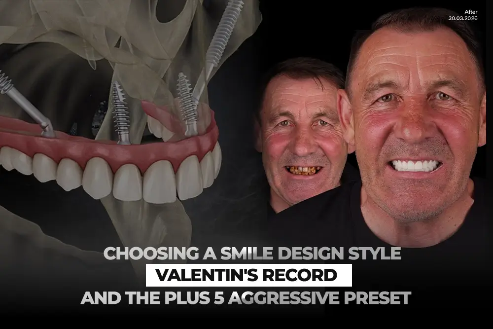 Choosing a Smile Design Style: Valentin’s Record and the Plus 5 Aggressive Preset