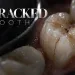 Cracked Tooth Symptoms, Diagnosis and Treatment Options