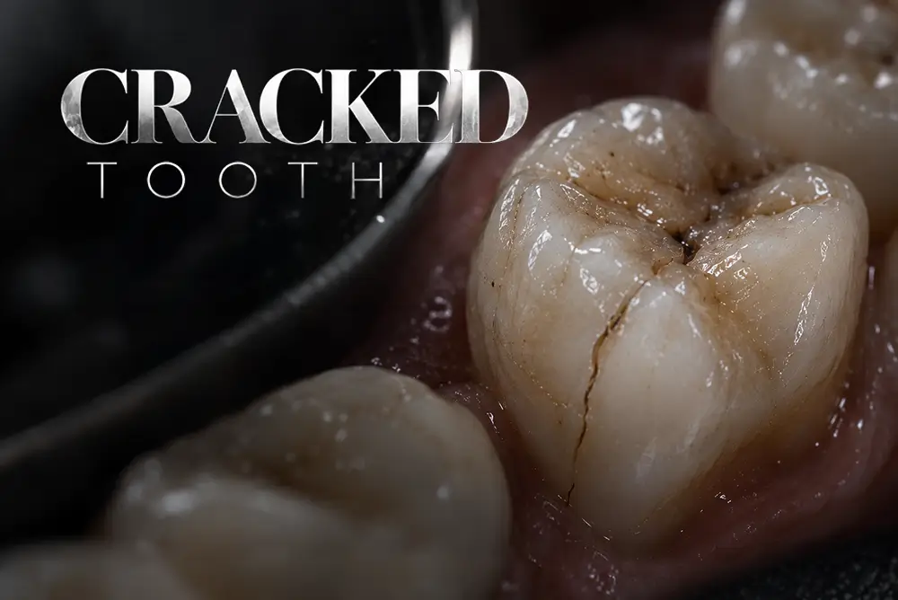 Cracked Tooth: Symptoms, Diagnosis and Treatment Options