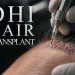 DHI Hair Transplant What the Choi Pen Changes and What It Does Not