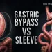 Gastric Bypass vs Sleeve A Structured Comparison of Two Operations