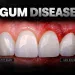 Gum Disease Signs, Stages and How It Is Treated