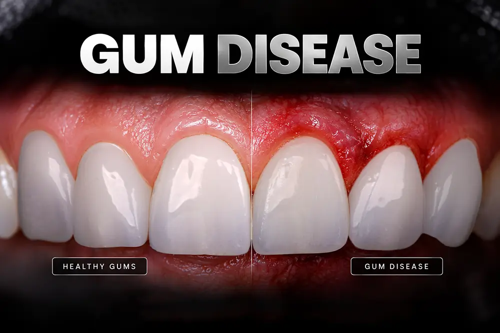 Gum Disease: Signs, Stages and How It Is Treated
