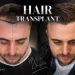 Hair Transplant Before and After What the Timeline Really Looks Like