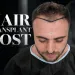 Hair Transplant Cost What Really Drives the Price