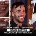 Six Root Canal Treatments Before Crowns Nicusor's 28 Unit Rebuild
