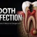 Tooth Infection Symptoms, Causes, Dangers and Treatment