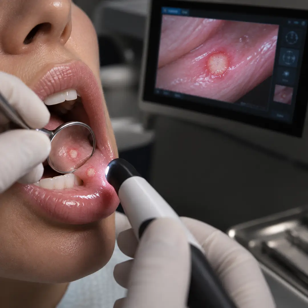 What Are Canker Sores