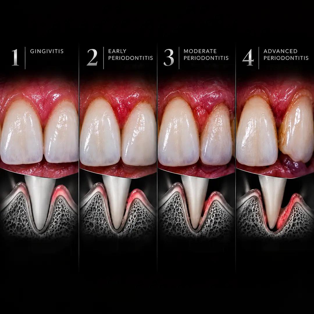 What Are the Signs of Gum Disease and What Does It Look Like