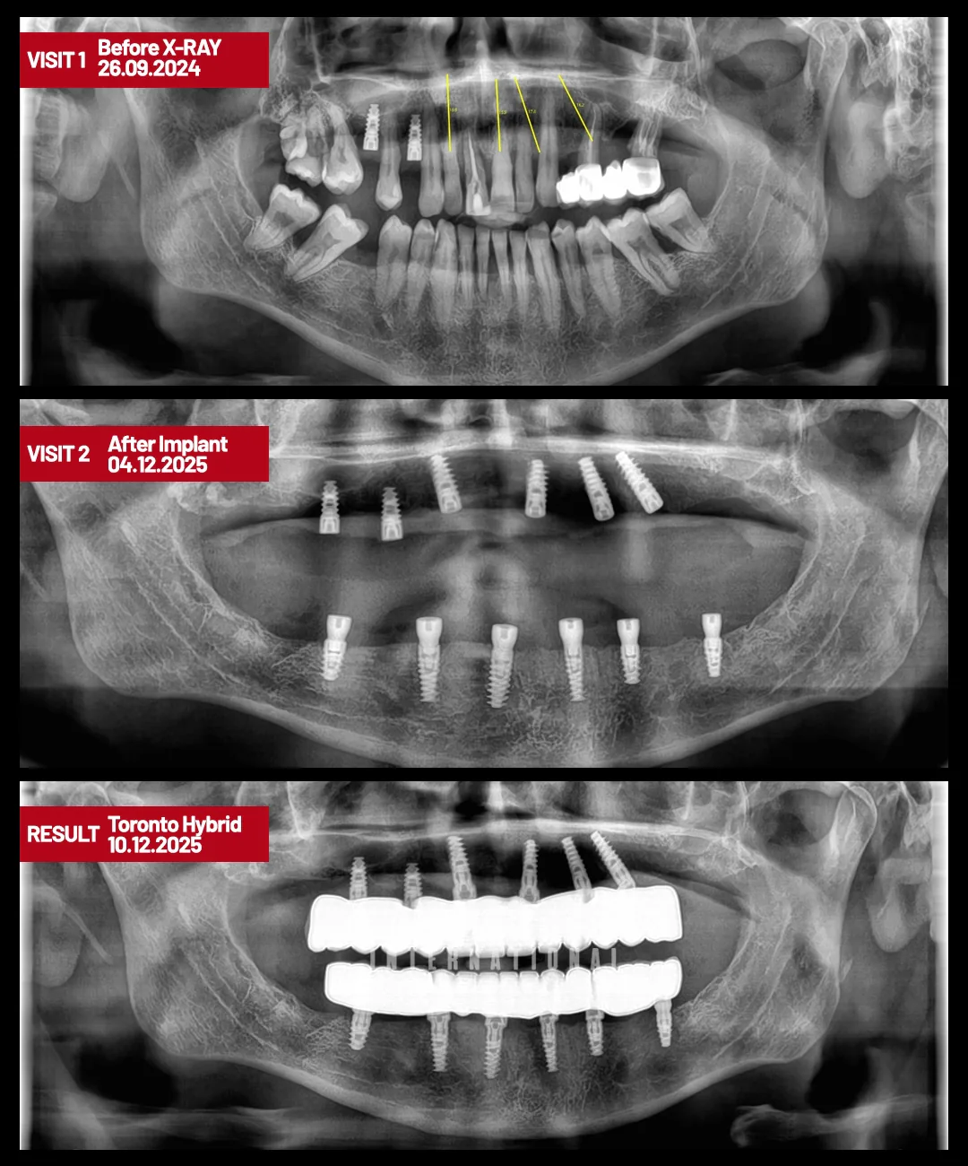 What Bar Retention and Screw Retention Each Mean