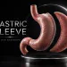 What Is a Gastric Sleeve The Procedure, the Follow-Up and the Long View