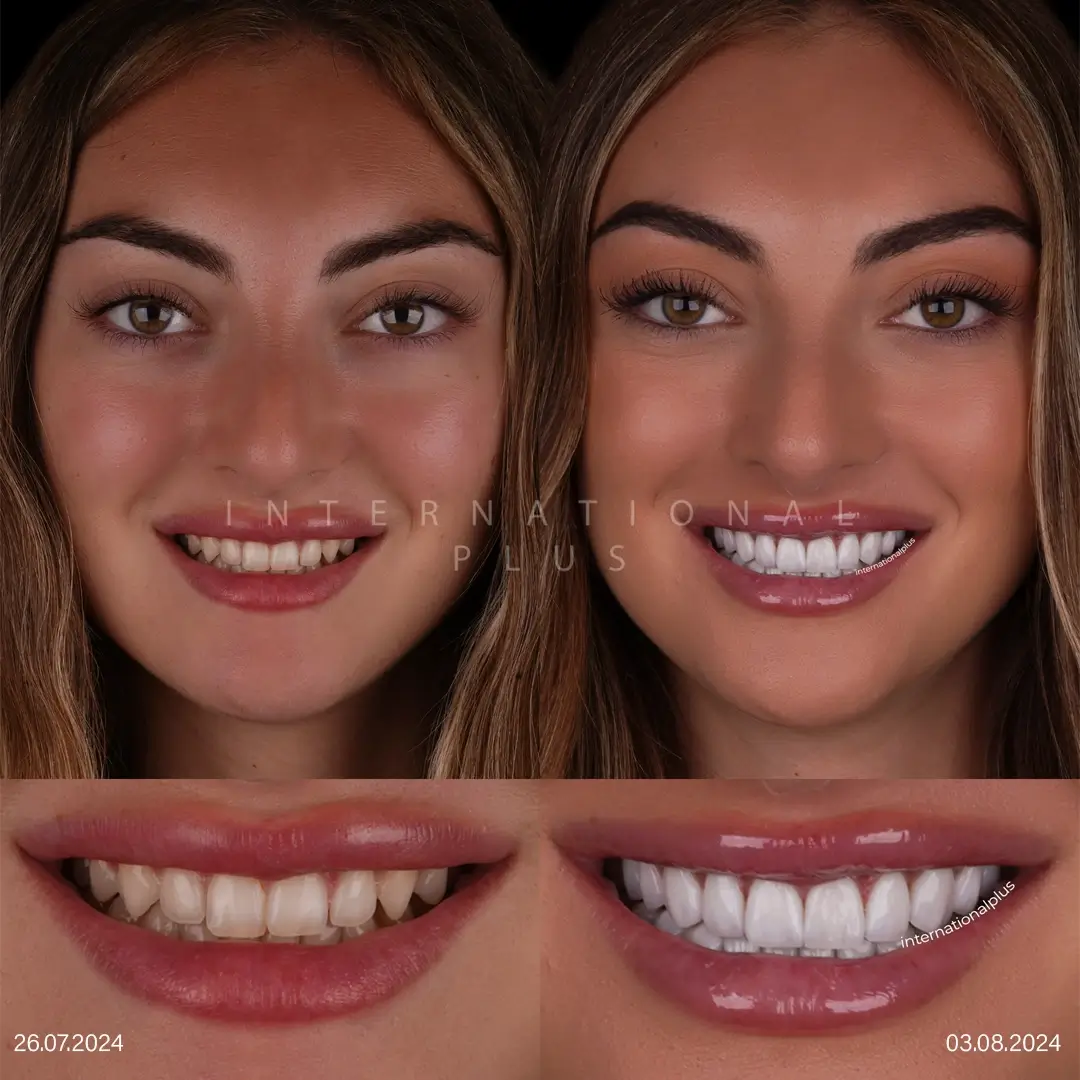 What Lithium Disilicate Is and Why It Suits Veneers