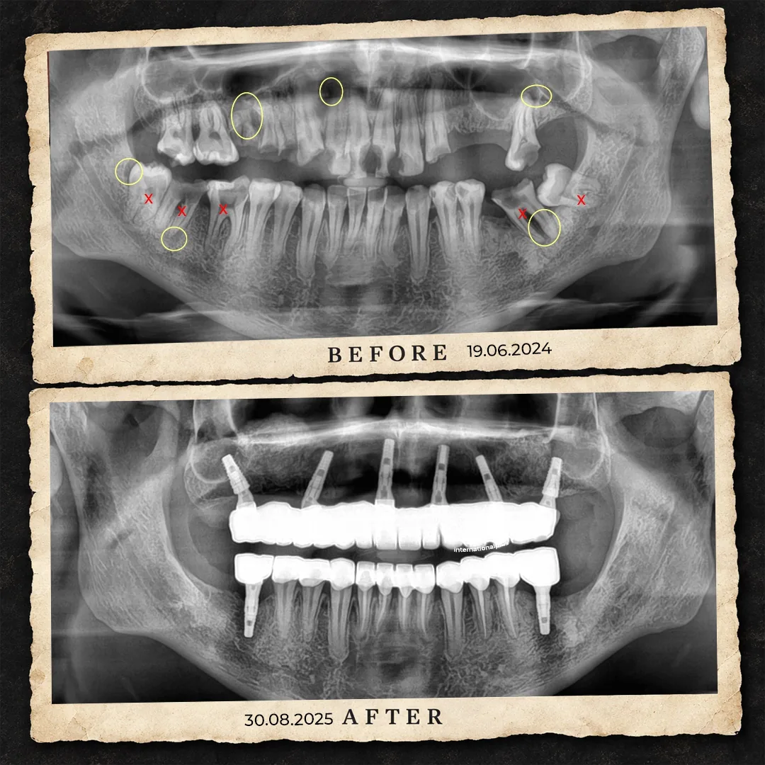 What a Dental Lab Remake Actually Is