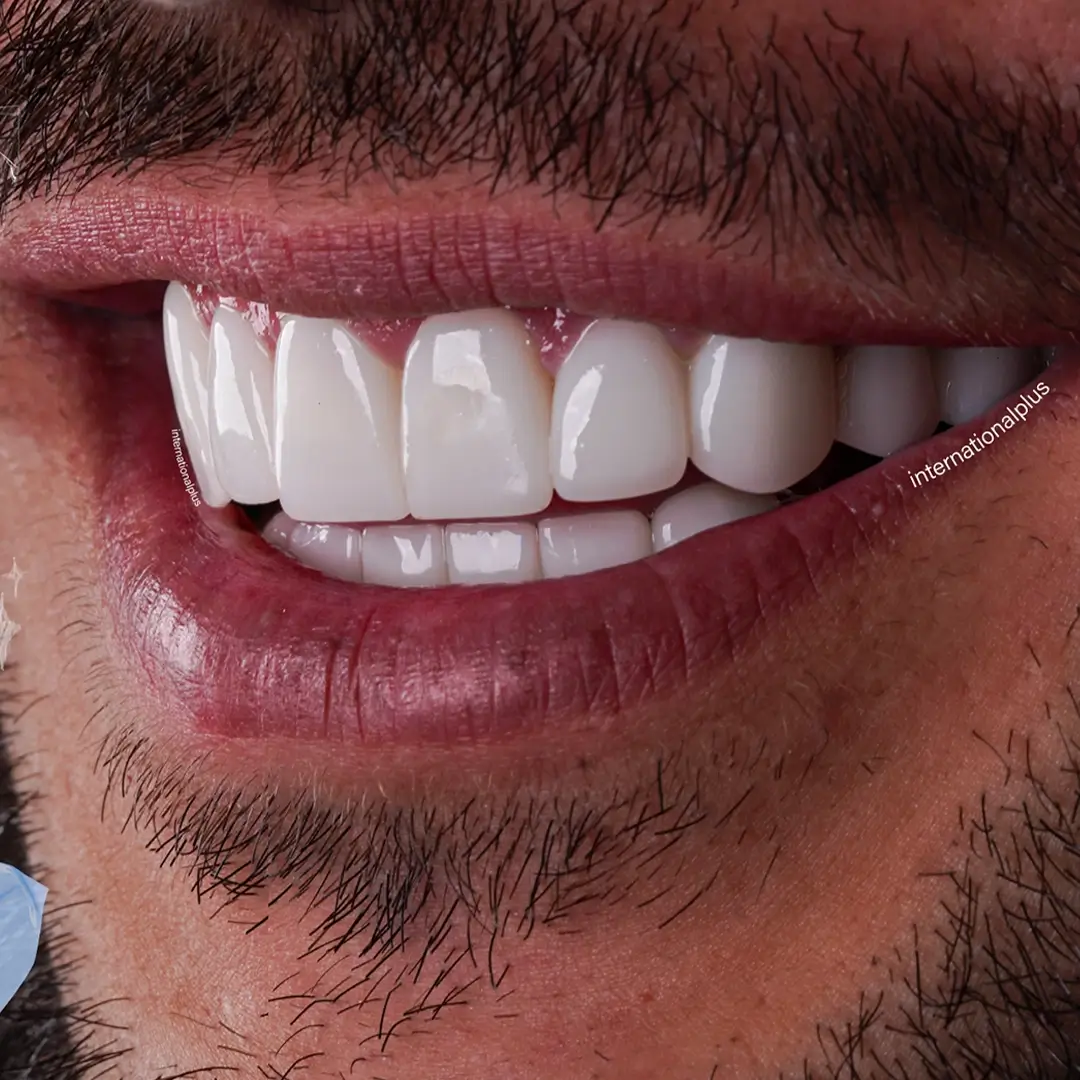 Why Endodontic Volume Changes a Plan